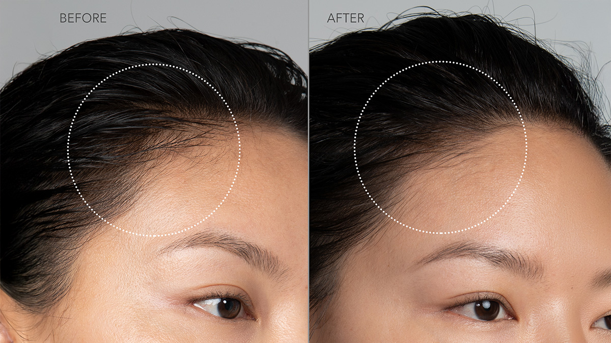 LUNA™ 4 hair before and after showing hair recovery on the temples